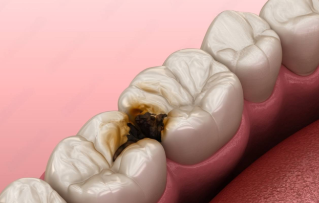 كيف نمنع التسوس بين الأسنان؟