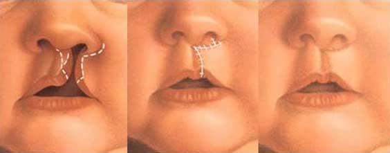 الشفة الأرنبية (Cleft Lip)
