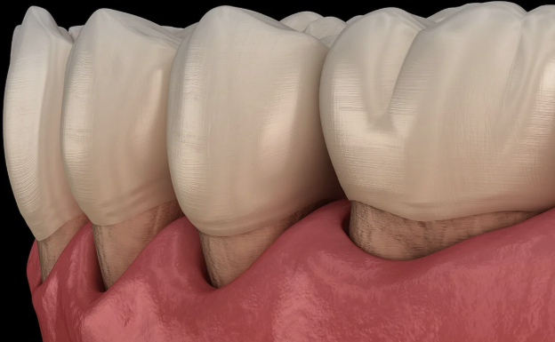 مخاطر تراجع اللثة أثناء العلاج التقويمي وطرق الوقاية