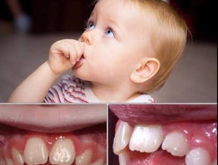 أفضل عمر للتدخل لعلاج عادة مصّ الإصبع بالأجهزة التقويمية