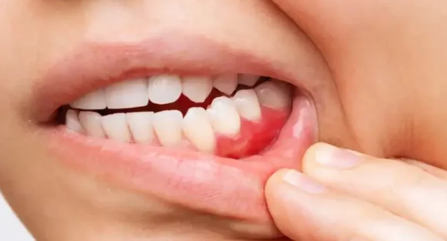 العلاقة بين ارتفاع ضغط الدم والتهابات اللثة