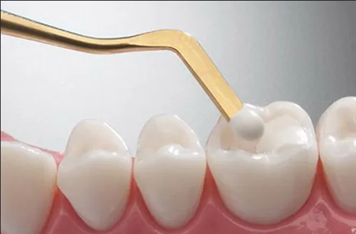 كيف نحافظ على أسناننا بعد تركيب حشوة تجميلية