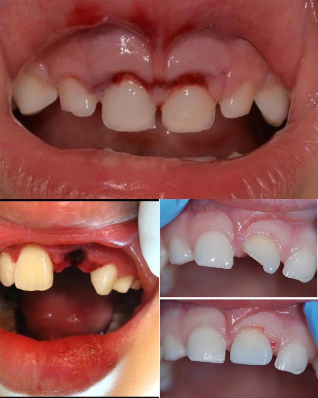 إصابات الأسنان عند الأطفال