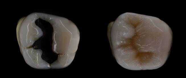 أثر الحشوات السنية غير المتقنة على صحة اللثة والأسنان